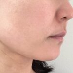 施術から3年以上経って顔脱毛「ディオーネ」の効果を再確認しました